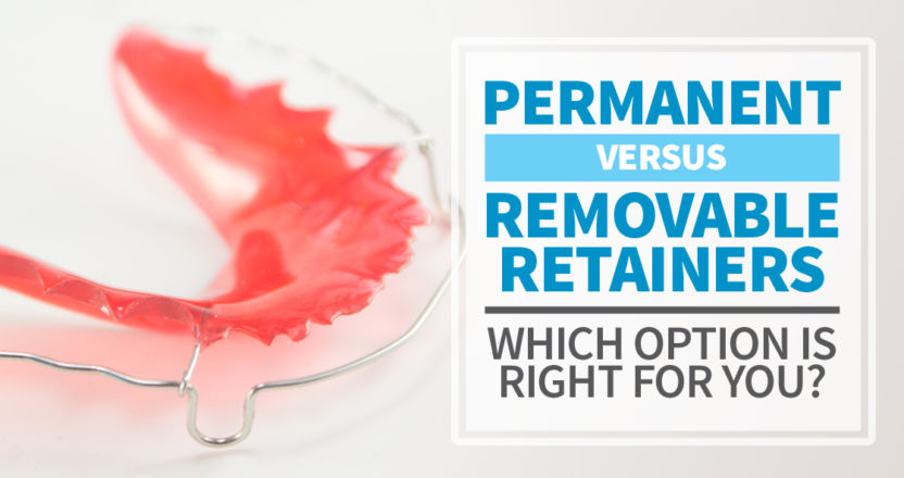 Permanent Vs Removable Retainers Midwest Orthodontics Center Blog