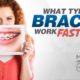 What Type of Braces Work the Fastest