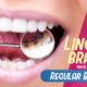 Do Lingual Braces Take Longer than Regular Braces?