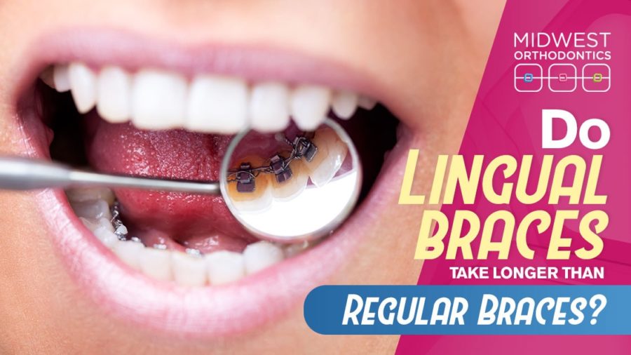 Do Lingual Braces Take Longer than Regular Braces?