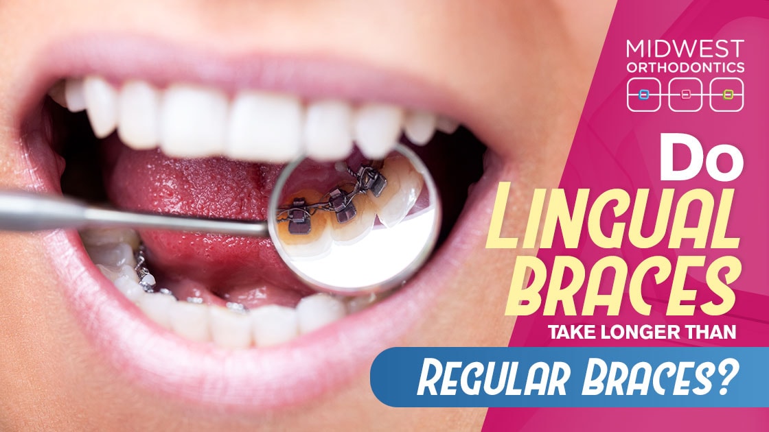 Do Lingual Braces Take Longer than Regular Braces? - Midwest Ortho