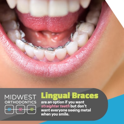 Midwest Orthodontics Center - Lingual Braces for straighter teeth