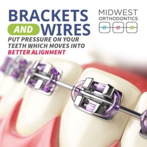 Why Do I Need My Braces Adjusted? - brackets and wires put pressure on your teeth - midwest orthodontics center